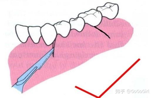 (2)角形瓣:龈缘连续切口的前端末端作松弛切口,跟梯形瓣差不多,但设计