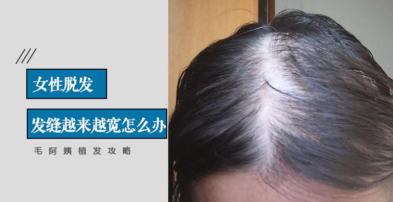 我是女生,头顶发缝越来越宽,这是“女性雄秃”吗? - 知乎