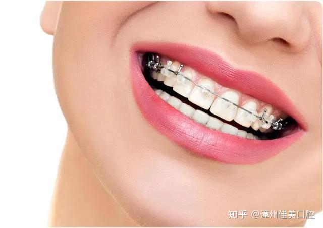 经济实惠型-托槽矫正金属托槽矫正技术是一种最传统的,也是价格最便宜