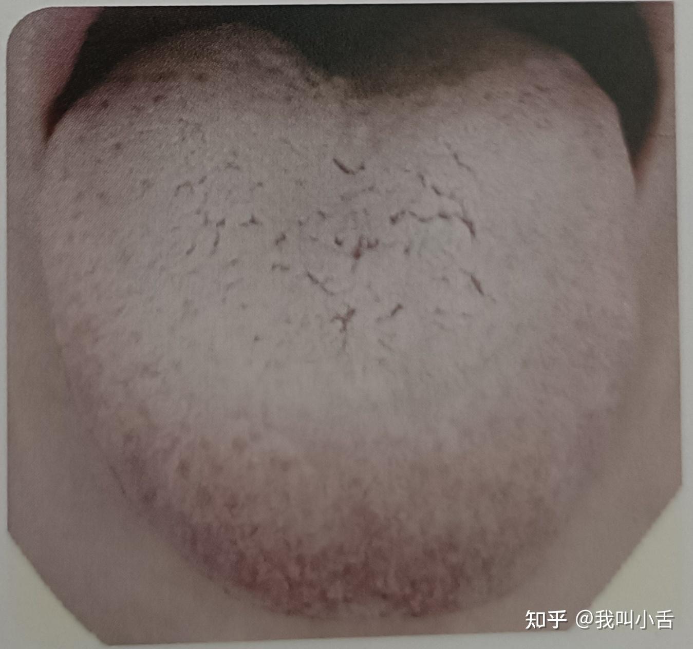 舌苔是如何形成的？白苔长什么样？如何判断自己的舌象呢？智能舌象助手来帮你！ - 知乎