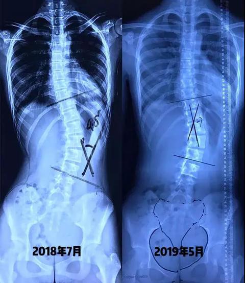 脊椎侧弯