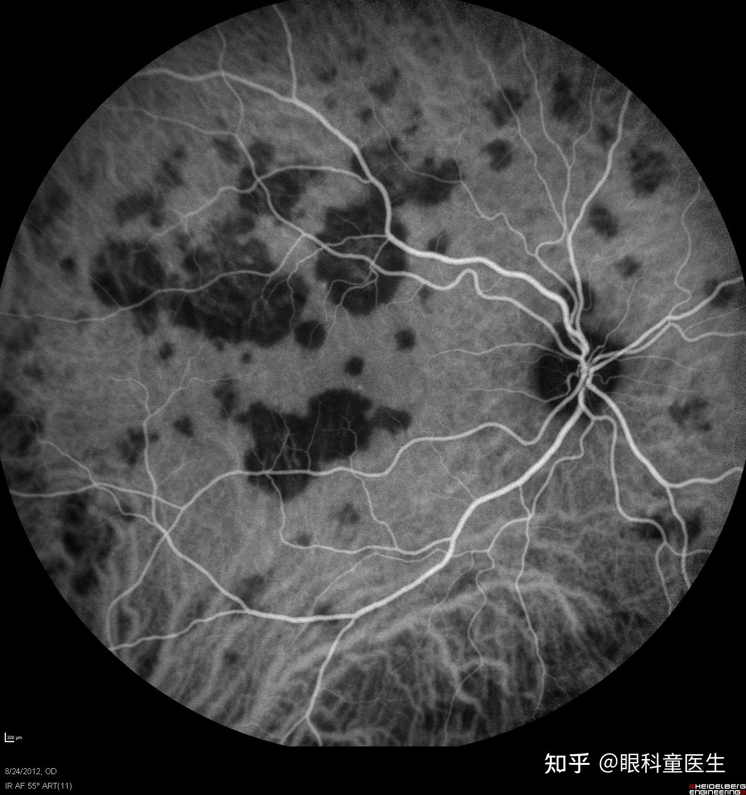 后葡萄膜炎18急性后极部多灶性鳞状色素上皮病变