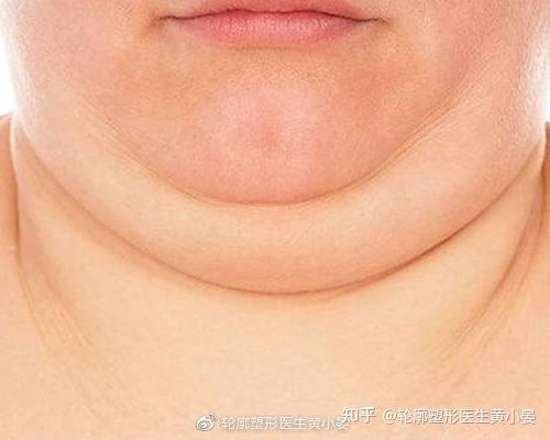 烦人的双下巴都有哪些手段可以改善