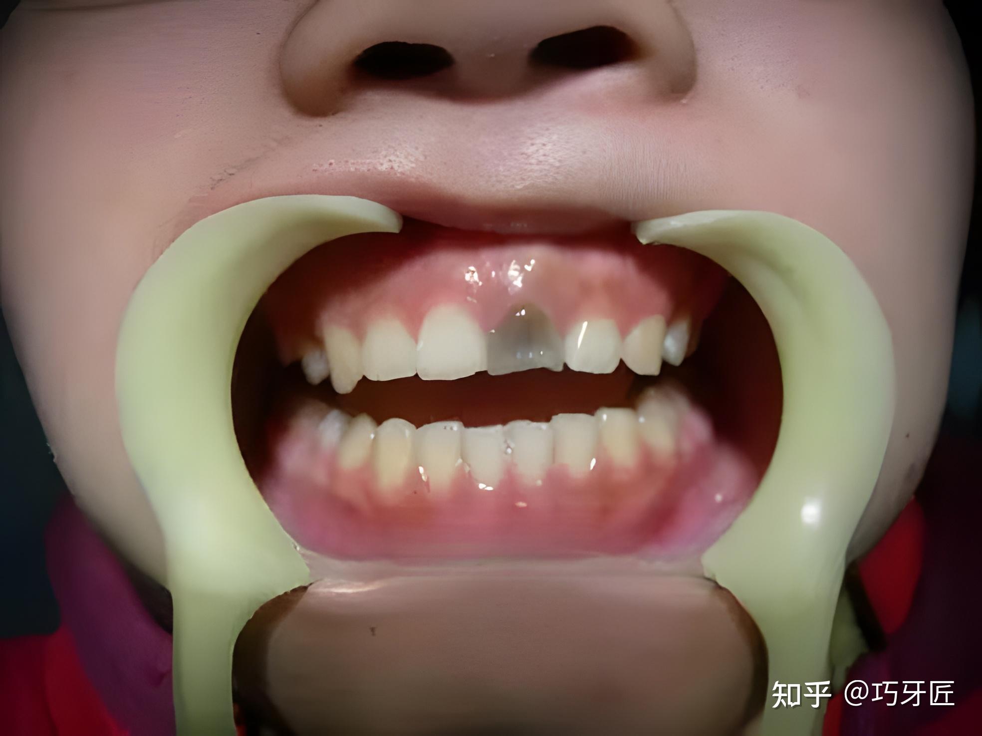 牙龈瘘管 - 搜狗百科