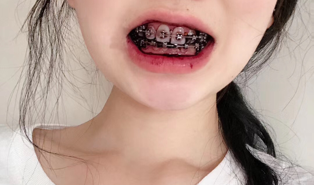 记录一下正畸带牙套的过程