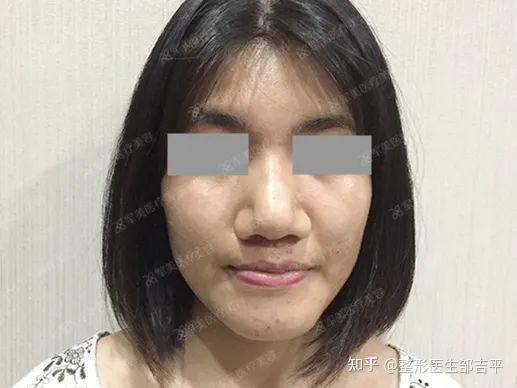 宽鼻会影响整个鼻子的精致度,该如何解决?