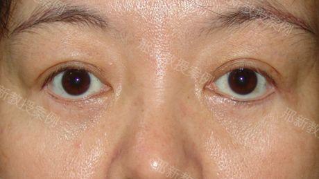 重度下睑退缩修复半年后反馈