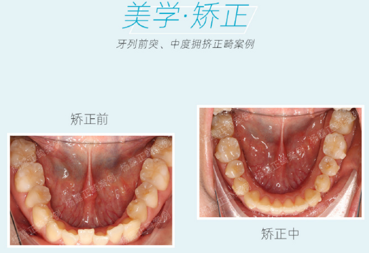 广州牙齿矫正整牙戴牙套如果患者不想拔牙矫正怎么办