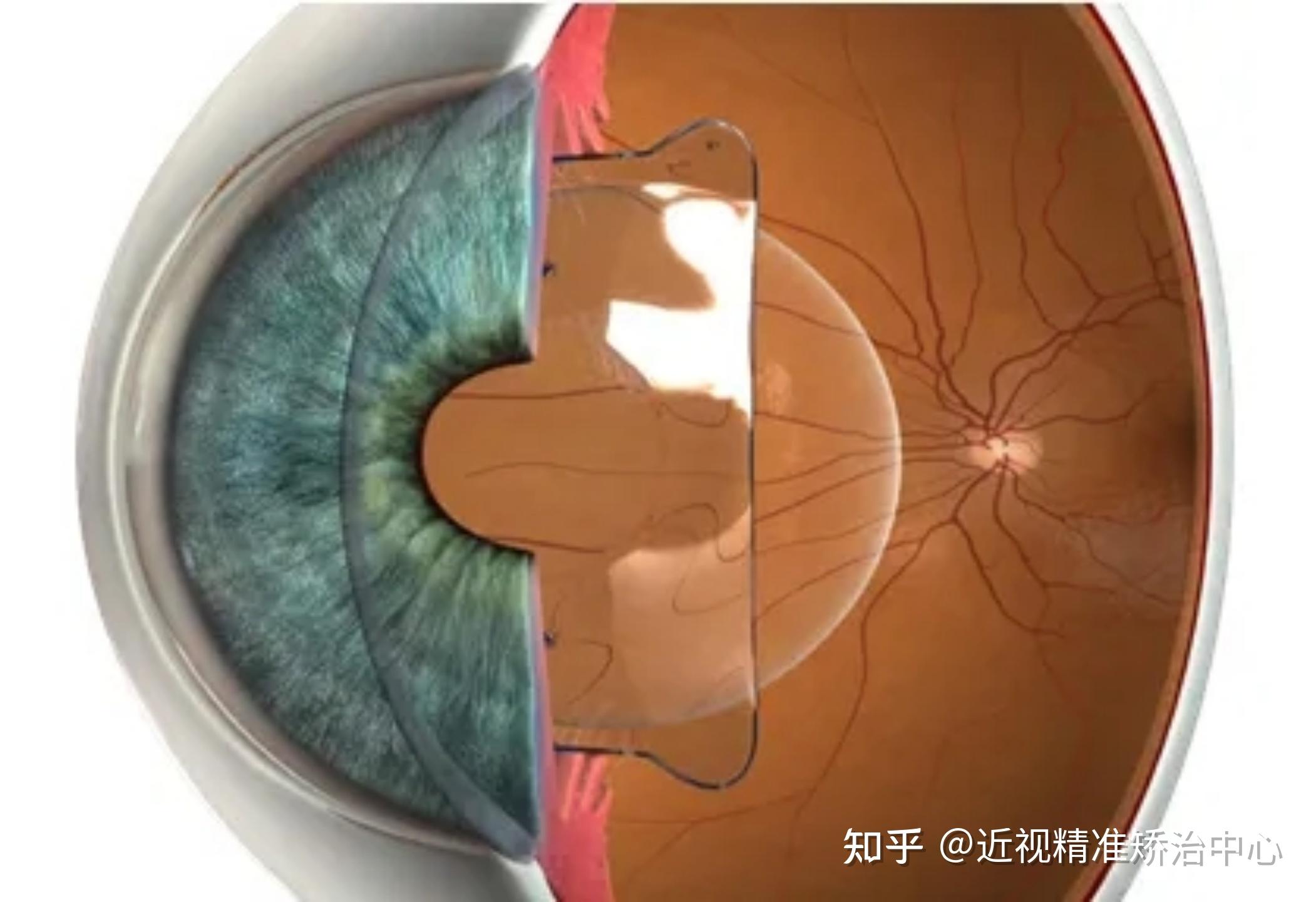 多焦点人工晶体在眼睛里边的样子丨临床图解三_www.yanke360.com