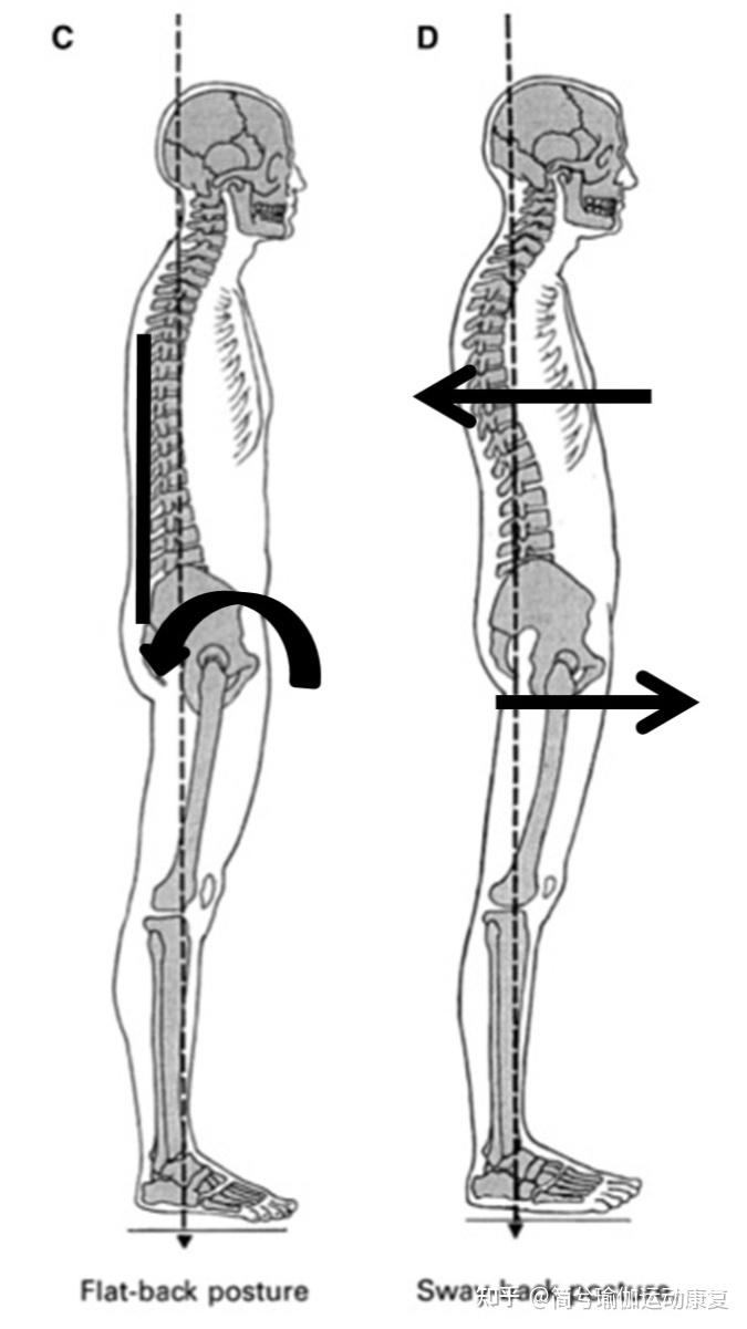 会出现长短腿,腰椎或骶髂关节病变,腰方肌或背阔肌缩短骨盆旋转,一侧