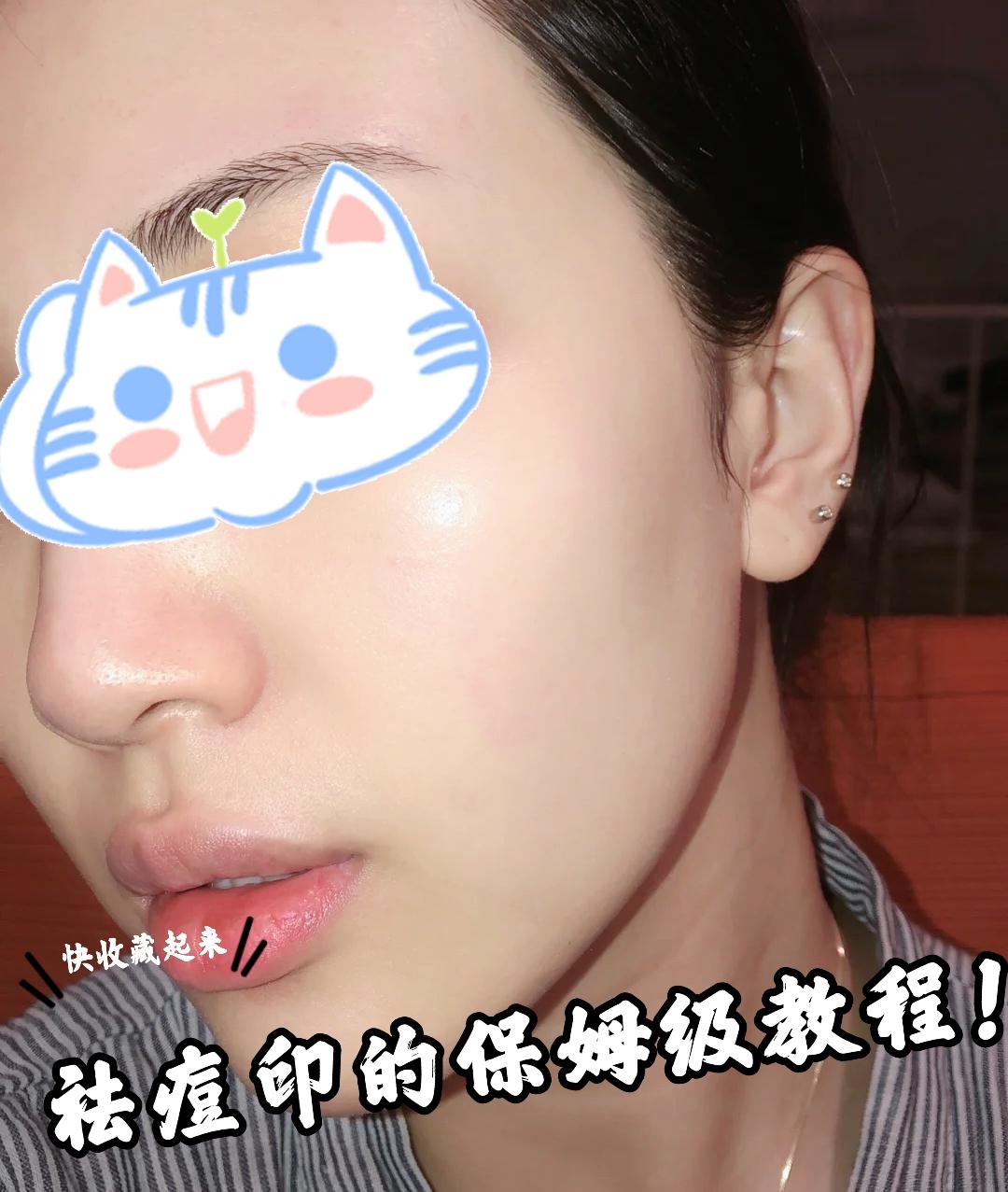 祛痘印亲测分享,祛痘痘 祛痘印小白看过来,平价祛痘印方法帮你轻松解决痘痘痘印困扰