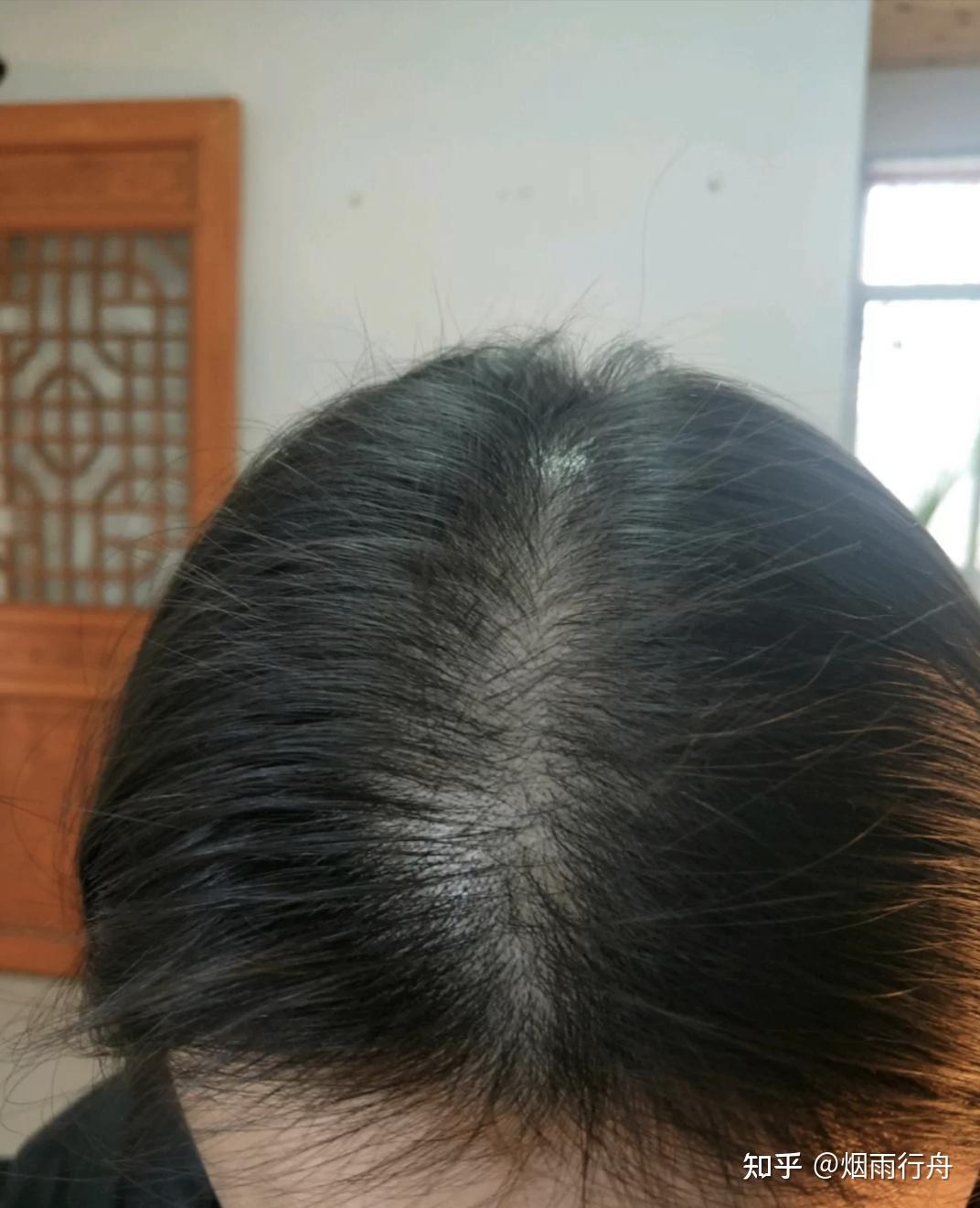 脱发两年了有没有比较好的防脱育发液脂溢性脱发真的无法痊愈了吗