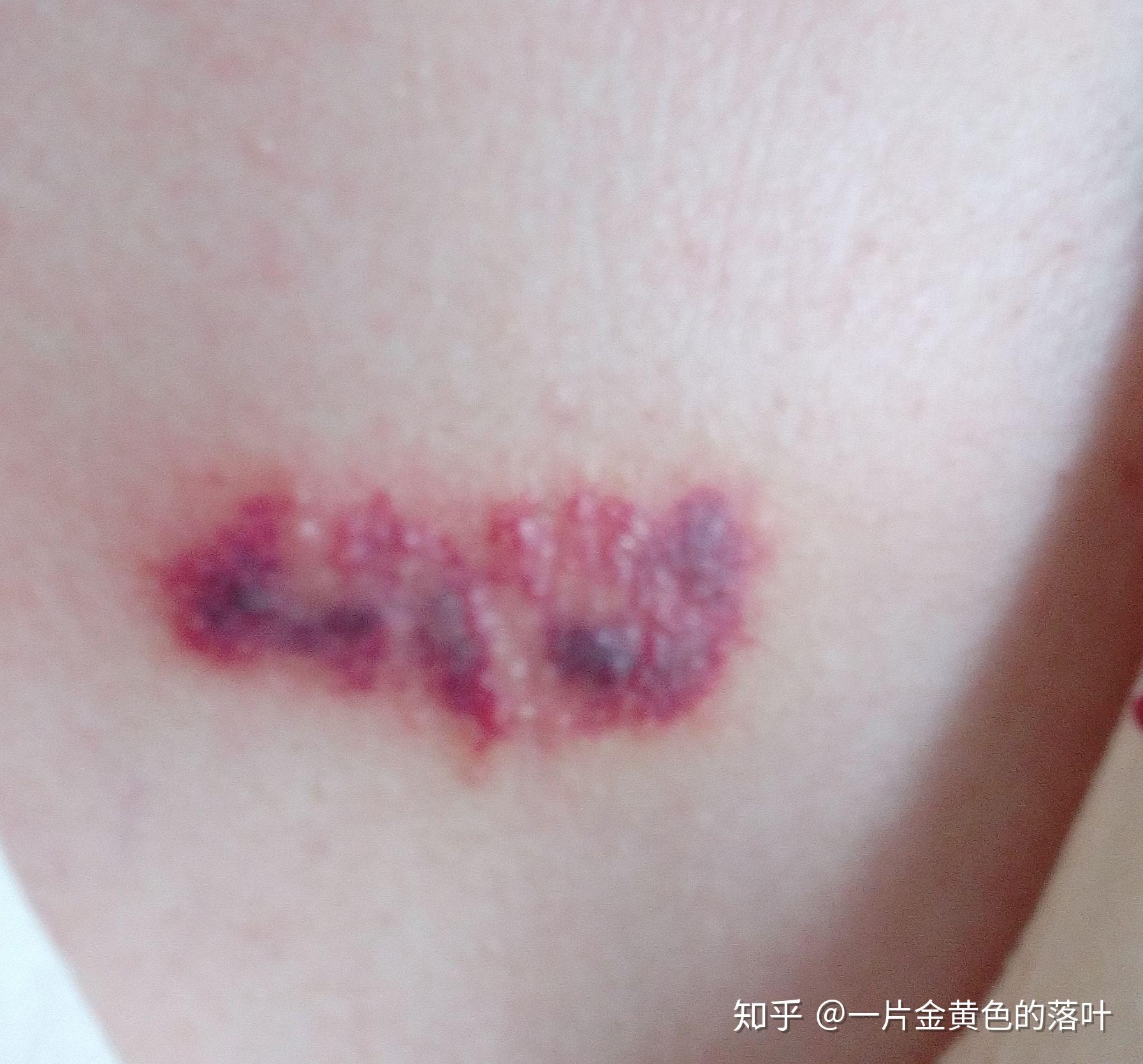 疤痕多久变软 v2-8ae3400494042fa771c51b11fea65aad_r.jpg