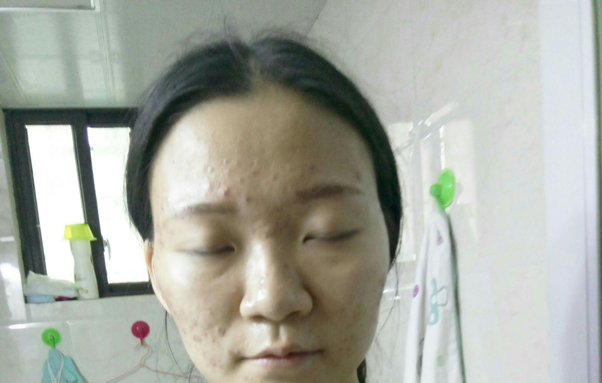 油脂分泌旺盛的痘痘肌适合什么样的洗面奶?