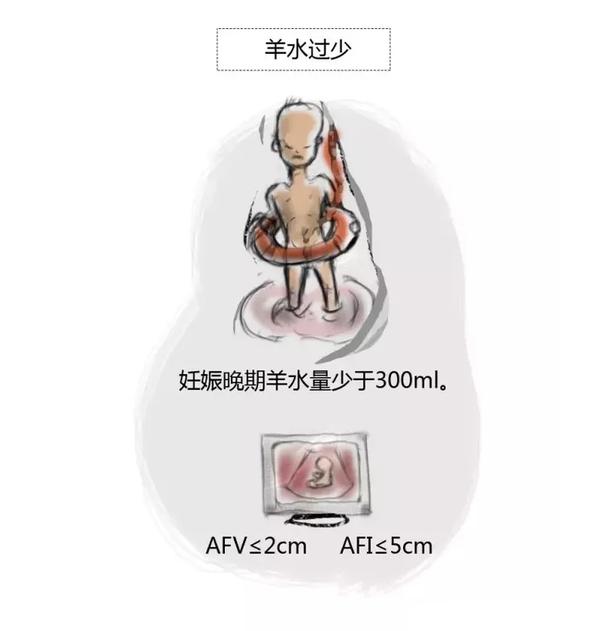 羊水过多过少都是问题咋整