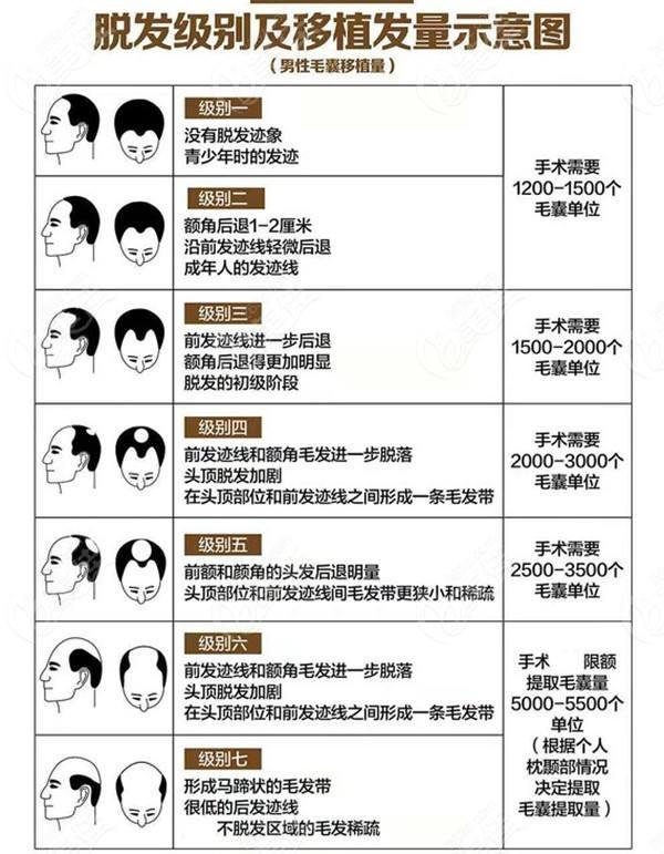 植发谈一谈植发那些事2022植发避坑指南植发技术植发机构医生选择费用