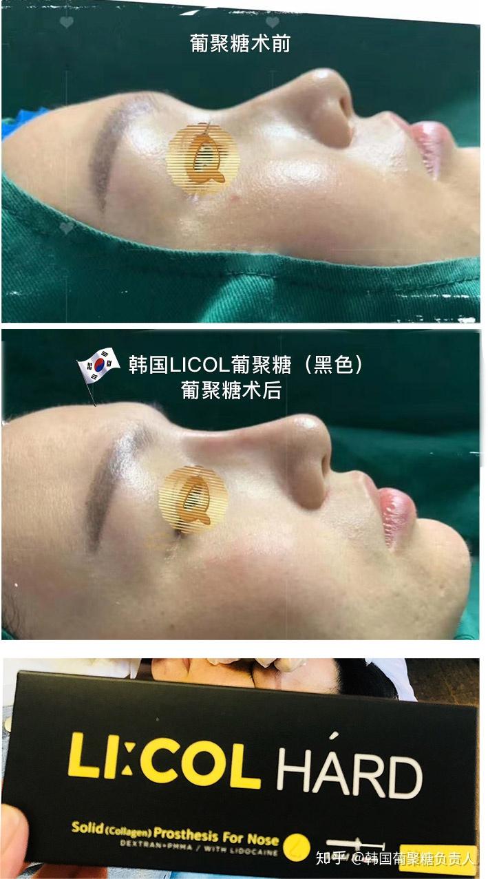 韩国licol葡聚糖生物肋骨鼻最新案例分享