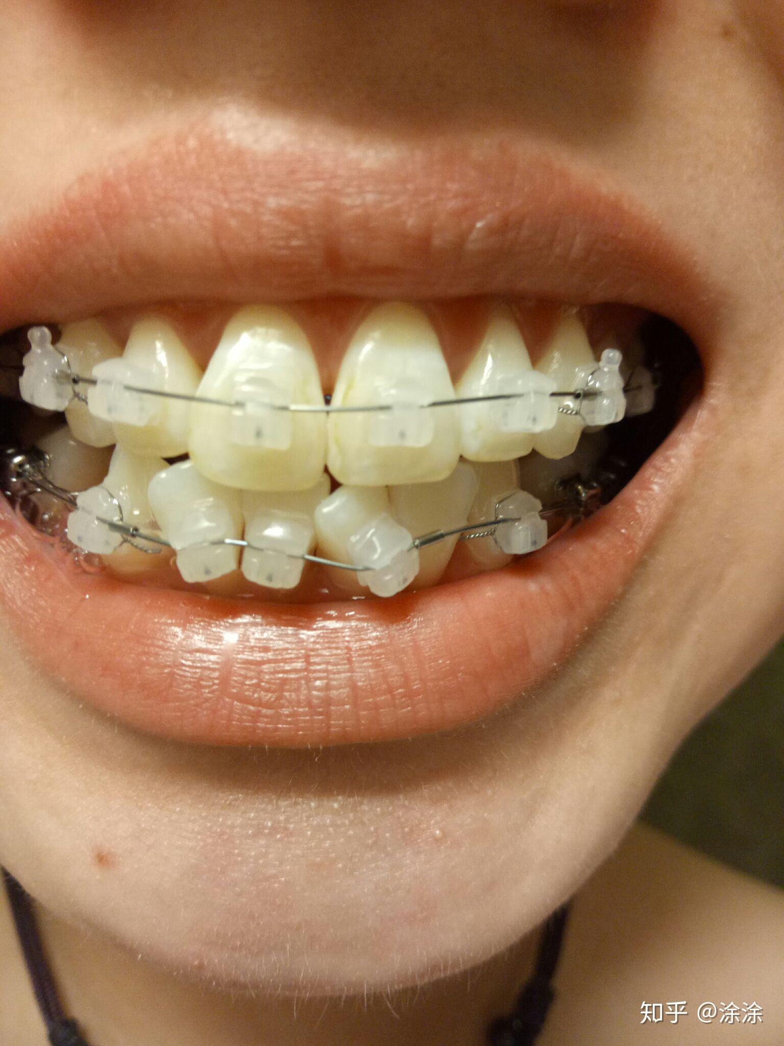 【牙齿矫正】带上金属牙套如何进行刷牙_哔哩哔哩_bilibili