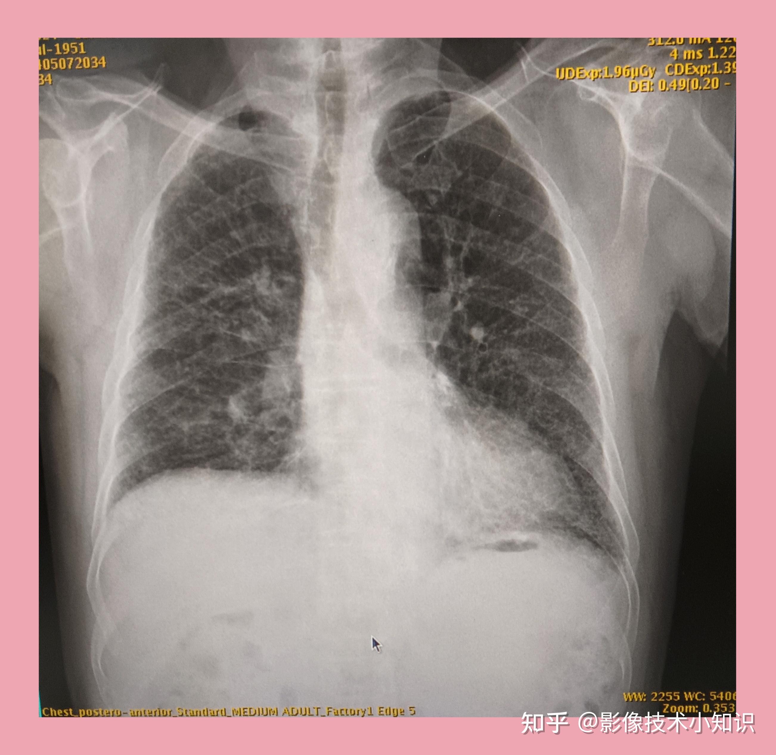 上图所示:右肺纹理增多,紊乱.右肺尖和中叶外野可以到钙化灶.