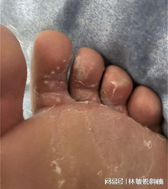 自愈者含泪分享治疗法,28天脚气去无踪 - 知乎