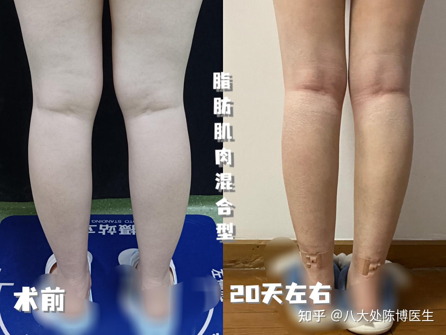 脂肪填充改善腿型术后，双腿对比 - 美好生活