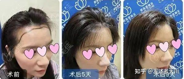 这两类人千万别做不剃发植发！碧莲盛的不剃发植发技术是最好的吗？从技术、案例、价格来回答 - 知乎