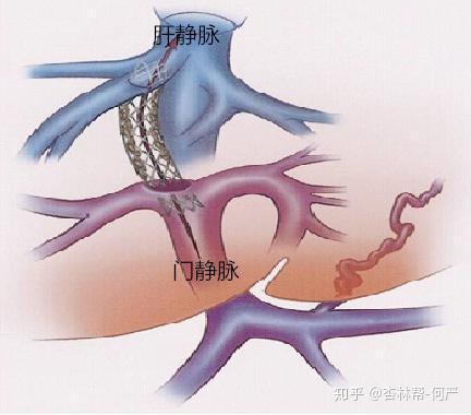 名医访谈上海东方肝胆外科医院夏勇肝硬化门脉高压症诊断治疗