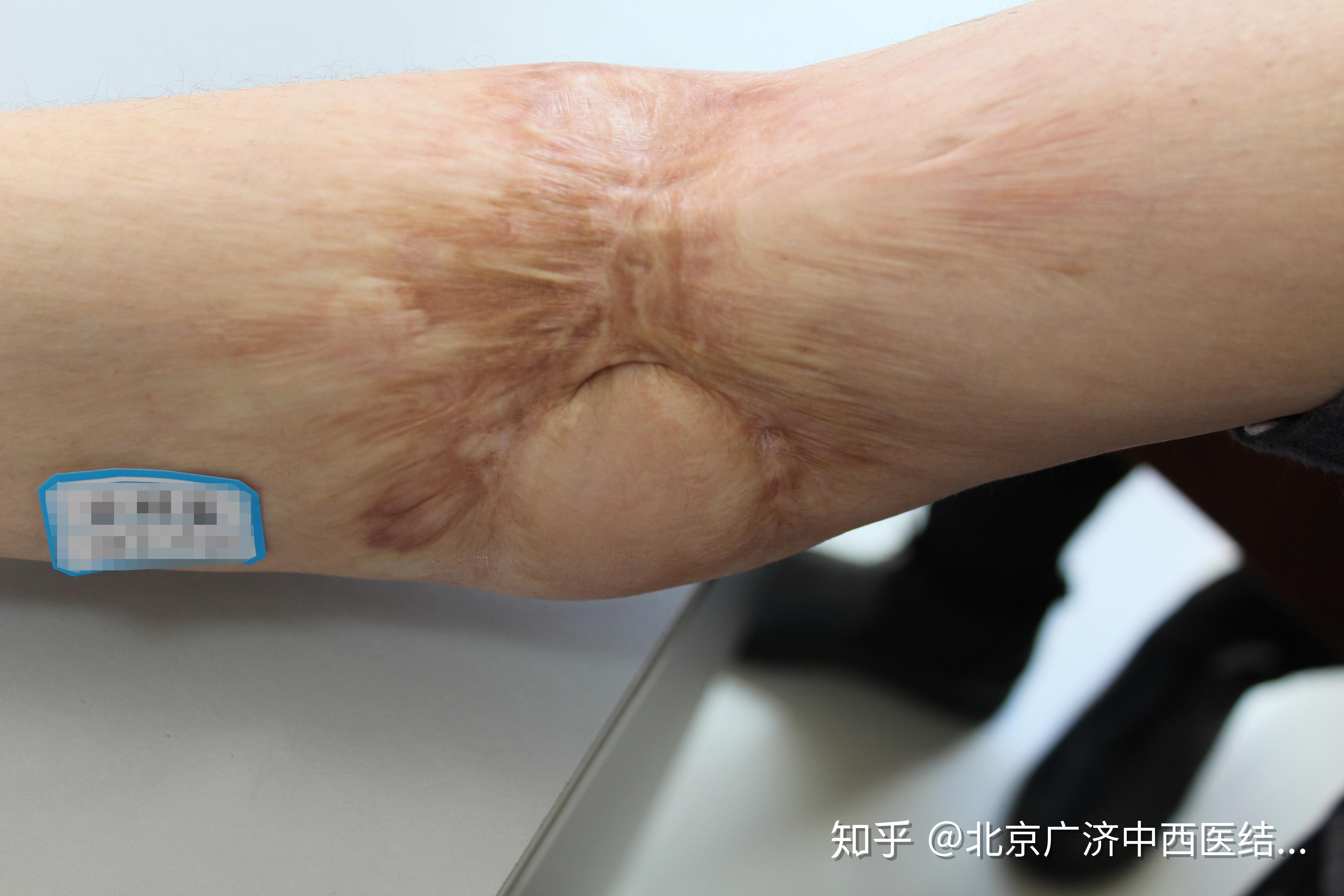 疤痕常识不同类型的烧烫伤疤痕如何修复