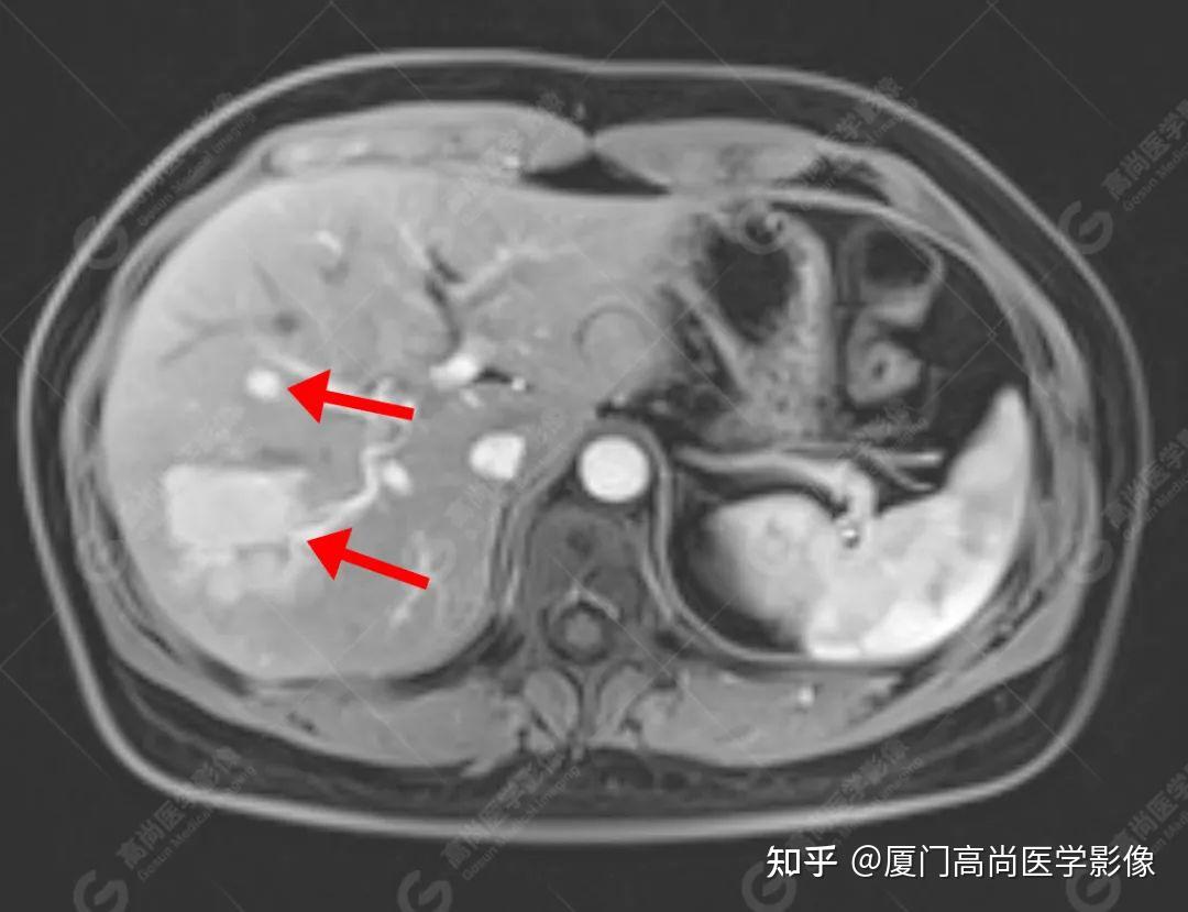 肝硬化背景下肝脏局灶性结节增生的影像学特点3例报告