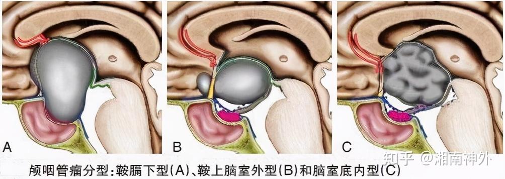 颅咽管瘤解剖位置图片