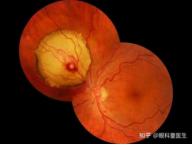 视网膜血管性疾病——6,获得性视网膜大动脉瘤