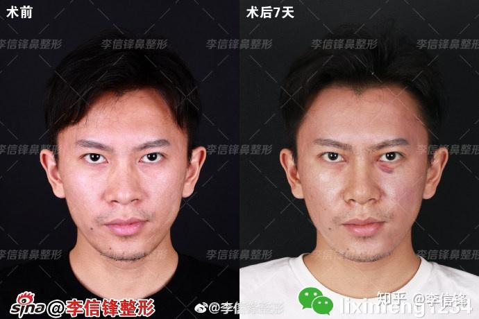 鼻翼整形_整形鼻翼整形_整形鼻翼缩小手术