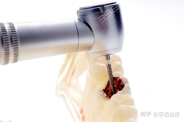 了解完补牙的全过程,其实补牙没那么可怕 - 知乎