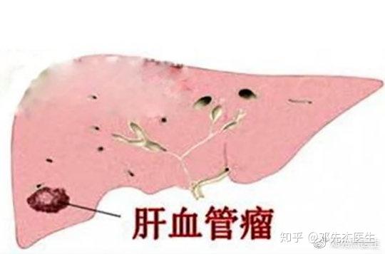 血管瘤专科医院：专业治疗的背后