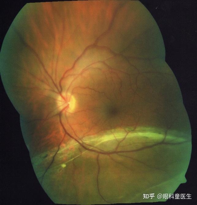 视网膜脱离与劈裂——1,孔源性视网膜脱离