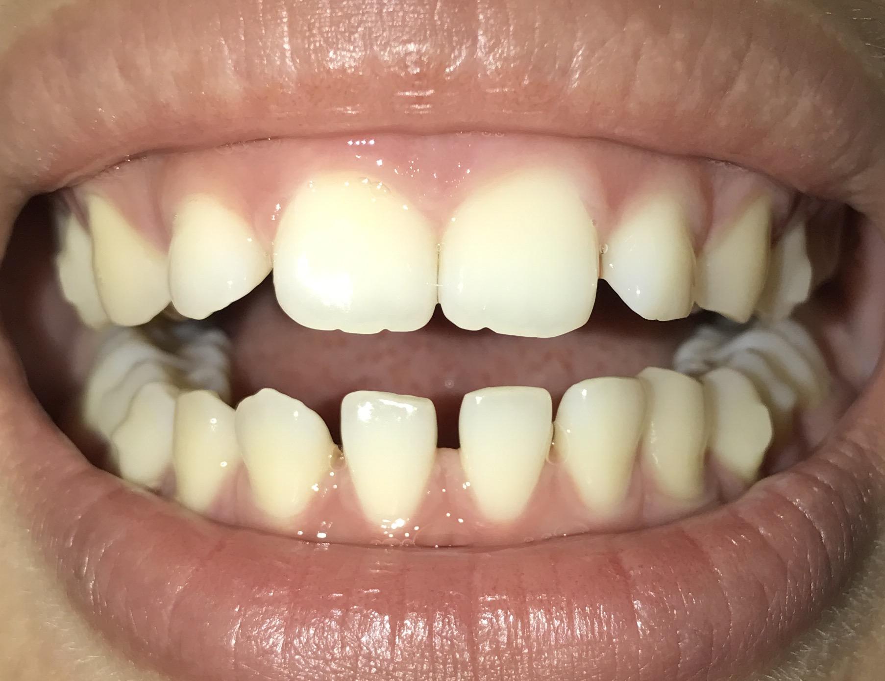 武汉牙齿矫正丨牙齿隐形矫正牙列拥挤+深覆合病例 - 知乎