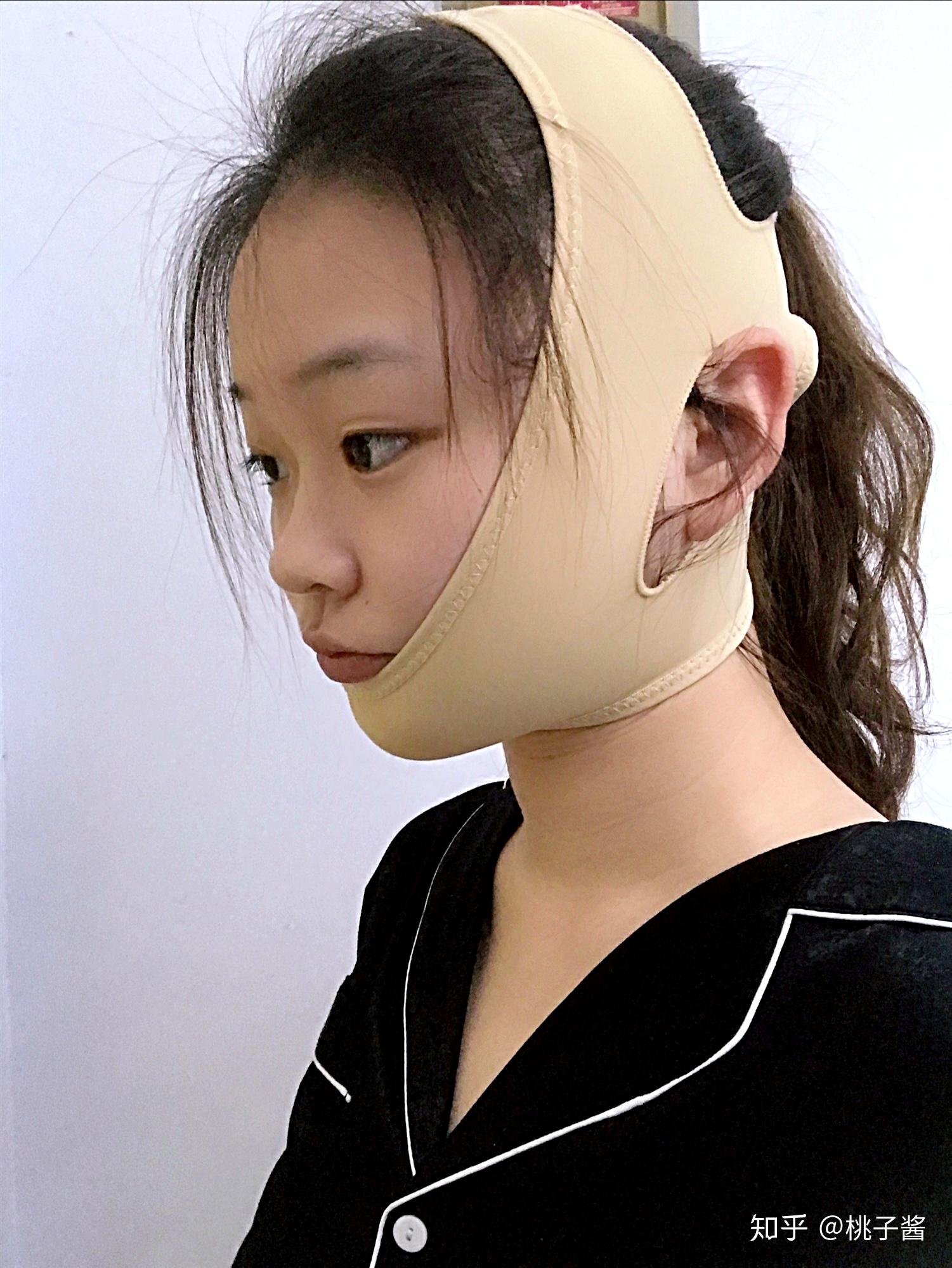 北京下颌角磨骨案例分享