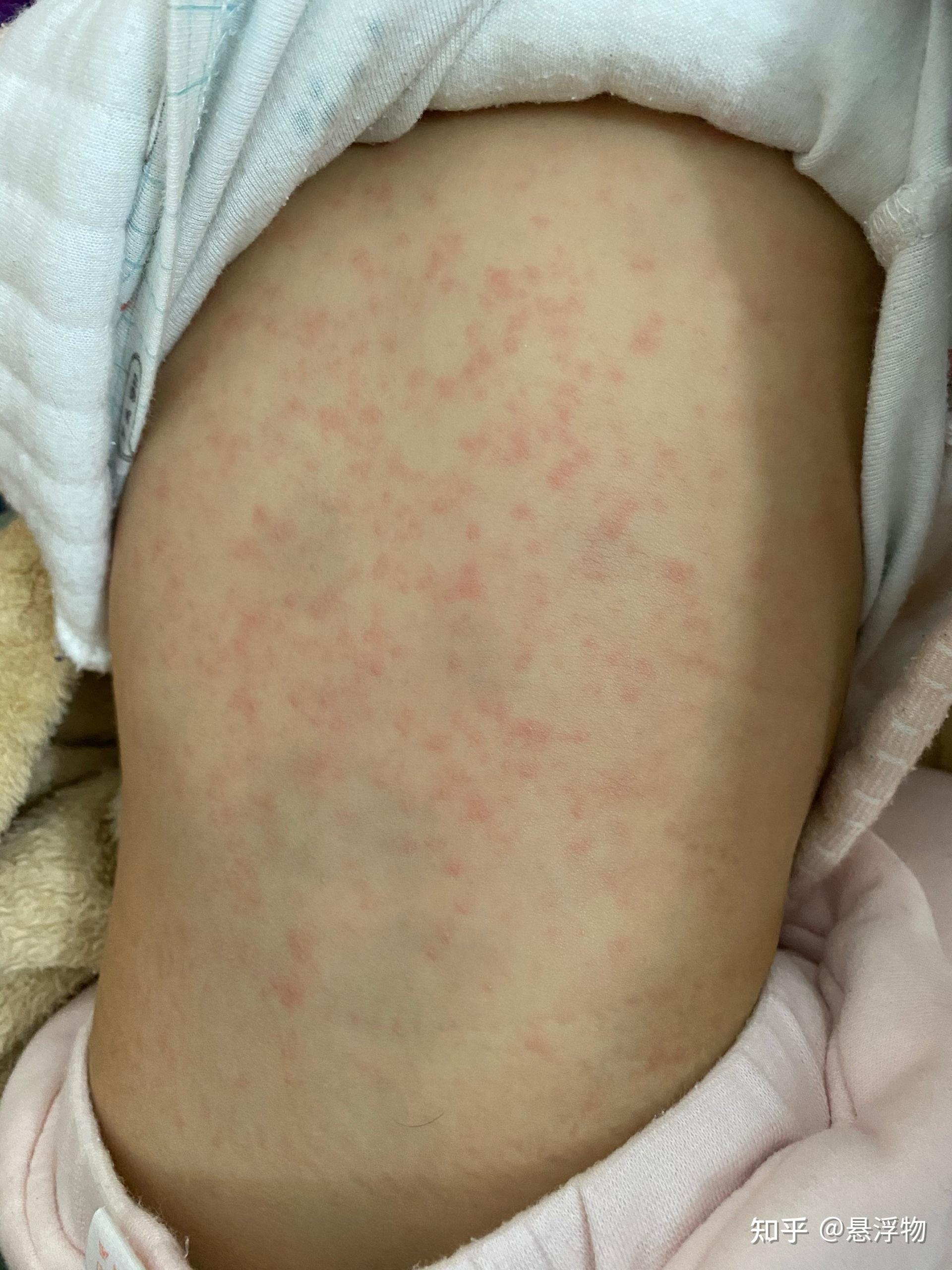 幼儿急疹 麻疹图片