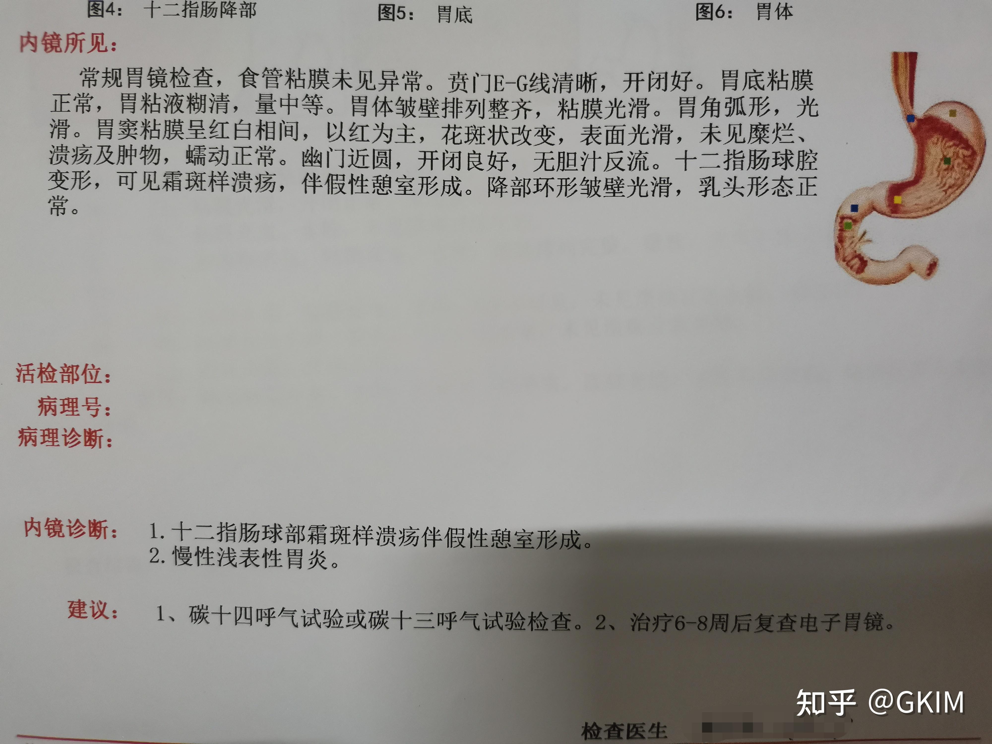 十二指肠溃疡怎么检查图片