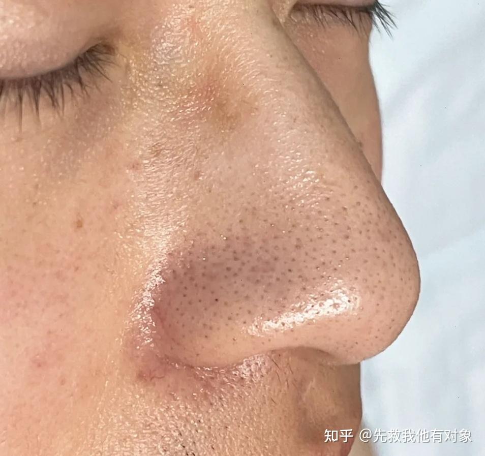 3,草莓鼻很显脏——祛黑头