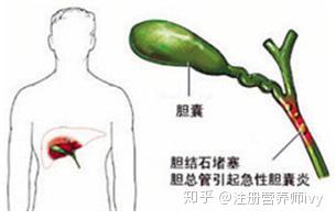 胆囊炎没什么大不了 牢记2点关键 推荐4类食物 身体恢复好又快 知乎