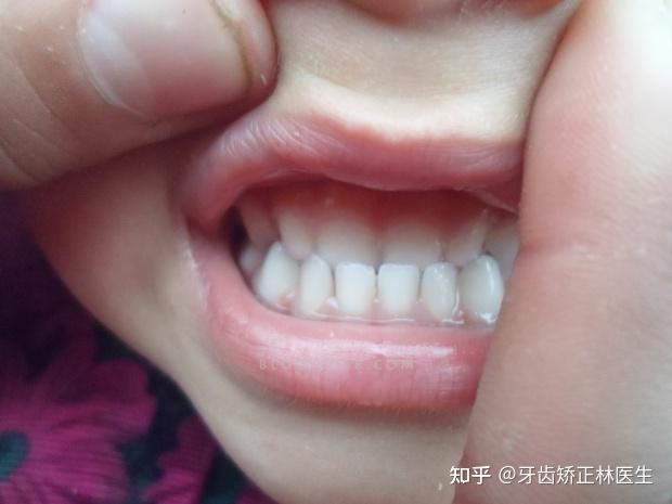 【发现即矫正】12岁前必须处理的12种儿童牙颌畸形!