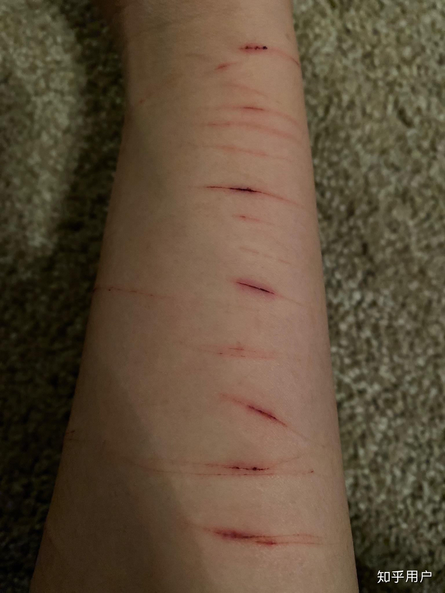 忧郁症自残是什么感觉