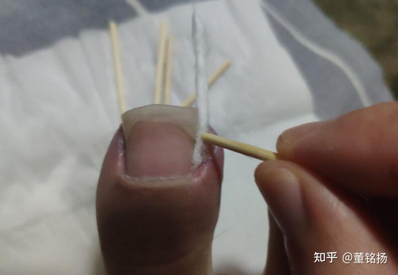 自述:用棉棒和双氧水治疗甲沟炎的过程