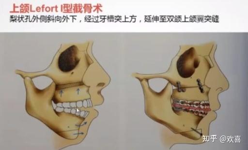 哪些情况需要做正颌手术,手术方案有哪些 - 知乎