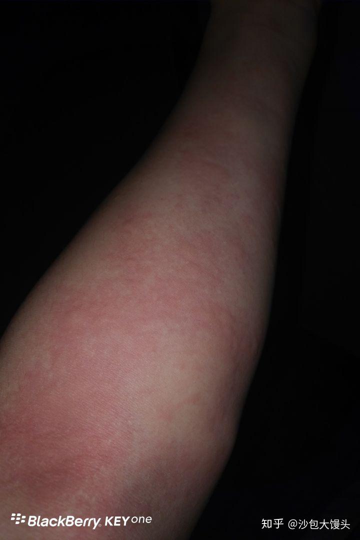 水土不服从过敏性鼻炎到荨麻疹的痛苦治疗之路