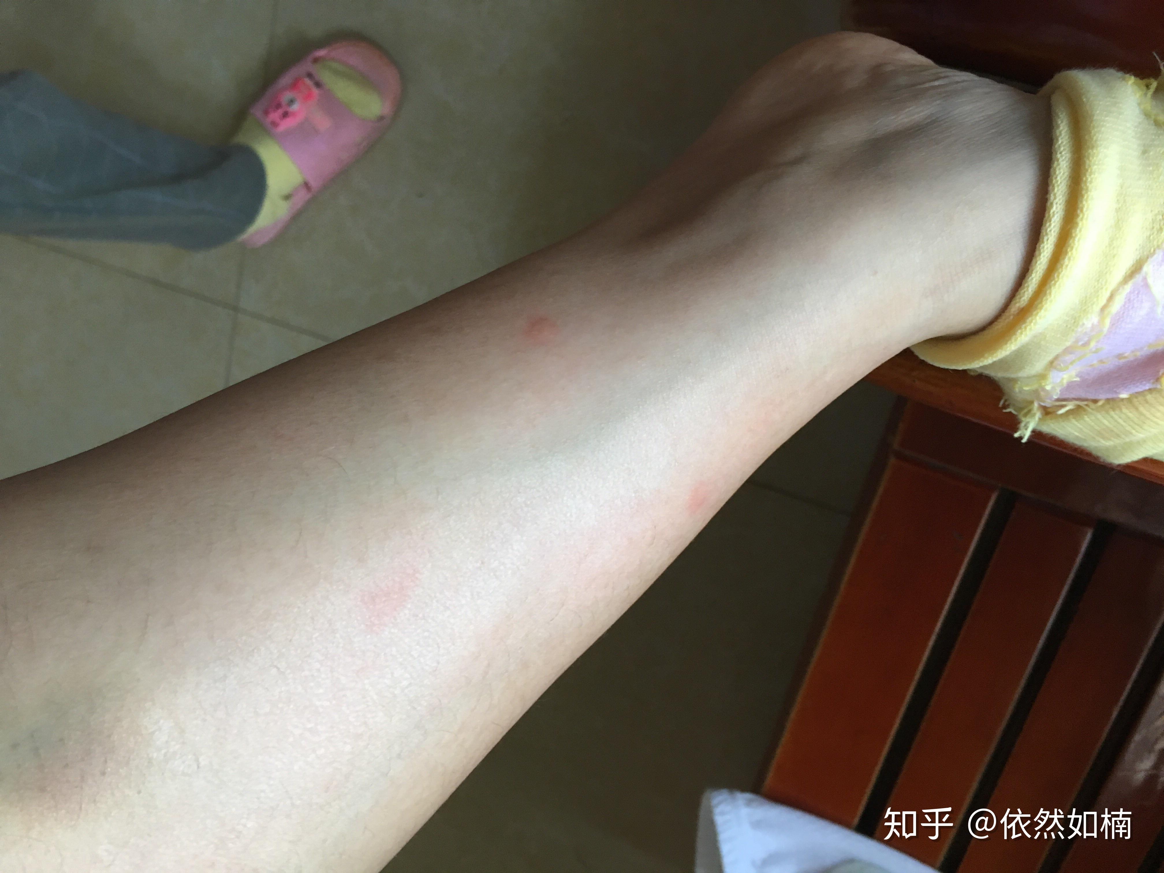 慢性荨麻疹治疗之路! - 知乎