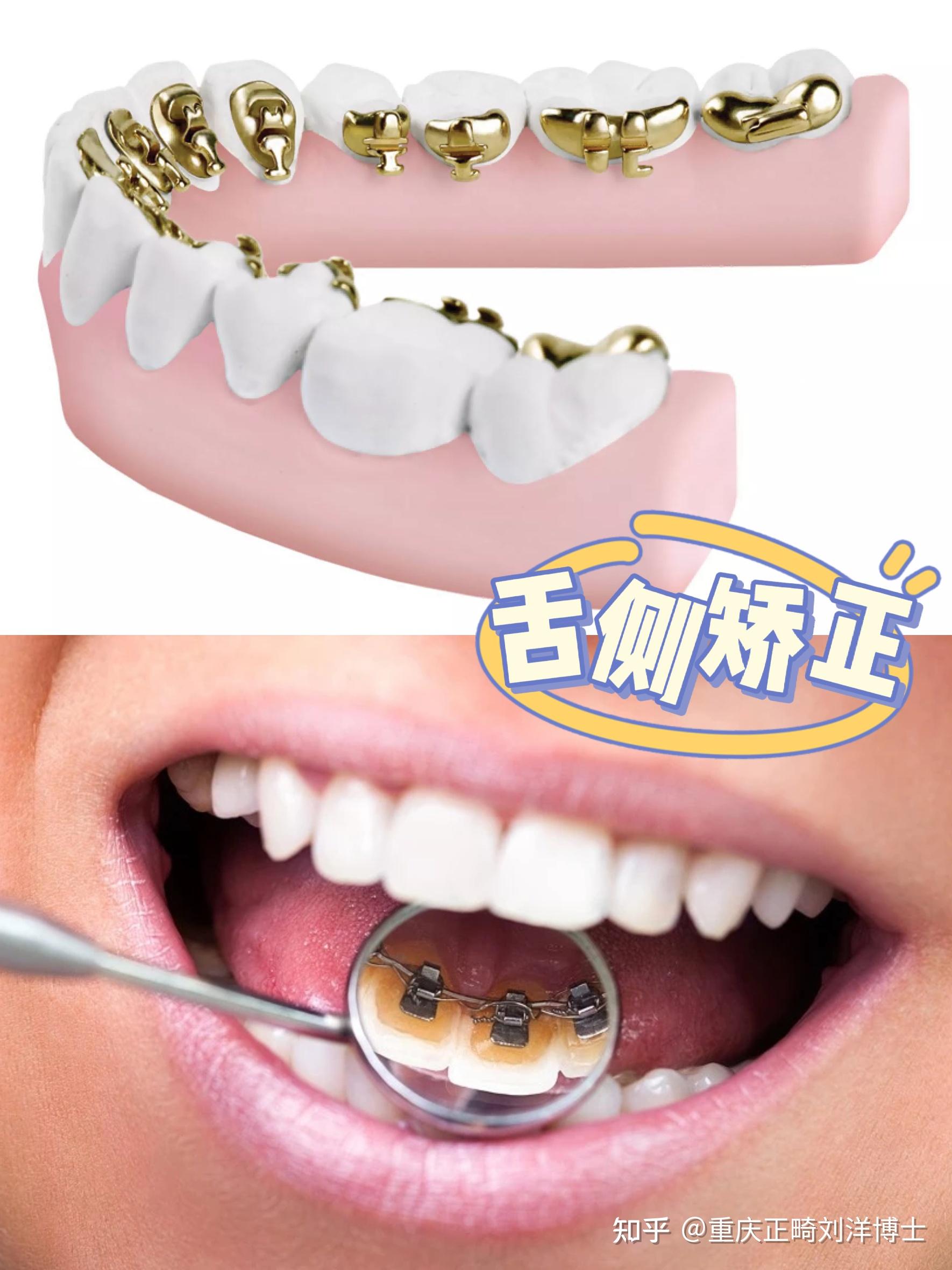 因为舌侧托槽更接近牙齿阻抗中心,在关闭牙列间隙时舌侧矫治技术较唇