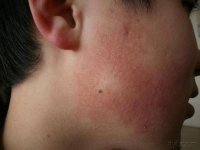 31毛囊红斑黑变病:两脸颊泛红,皮肤粗糙,常觉得发热