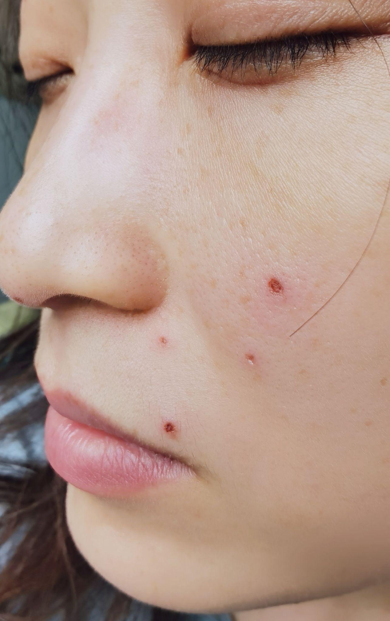 记录激光去痣 - 知乎